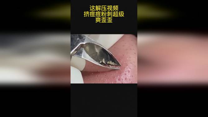 最新擠膿包視頻，見證變化的力量，自信與成就感的誕生之地