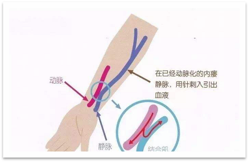 靜脈瘺最新資訊，掌握最前沿的健康信息